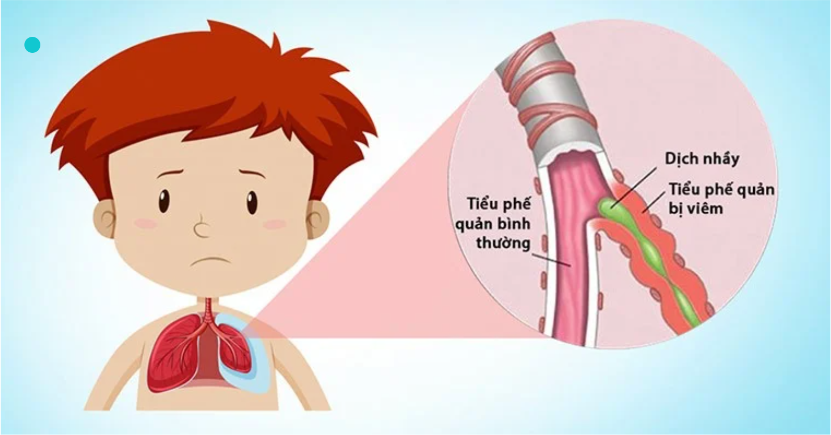 Viêm Tiểu Phế Quản Ở Trẻ