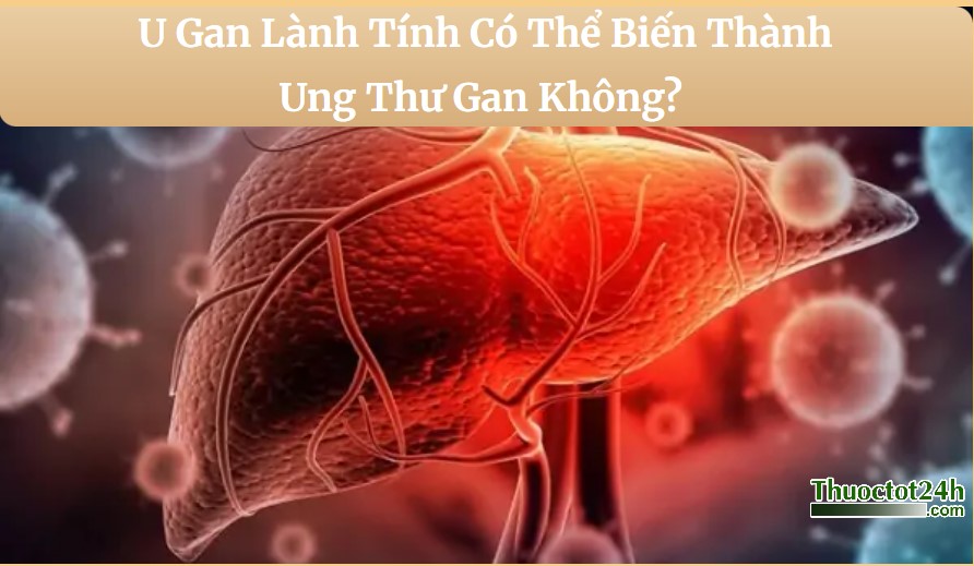 u gan có chuyển sang ung thư gan