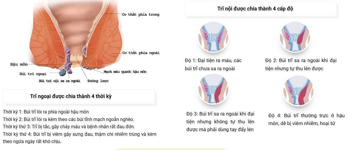 4 cấp độ trĩ
