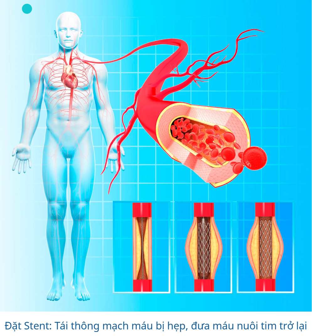 C&aacute;ch chữa Bệnh Mạch V&agrave;nh 