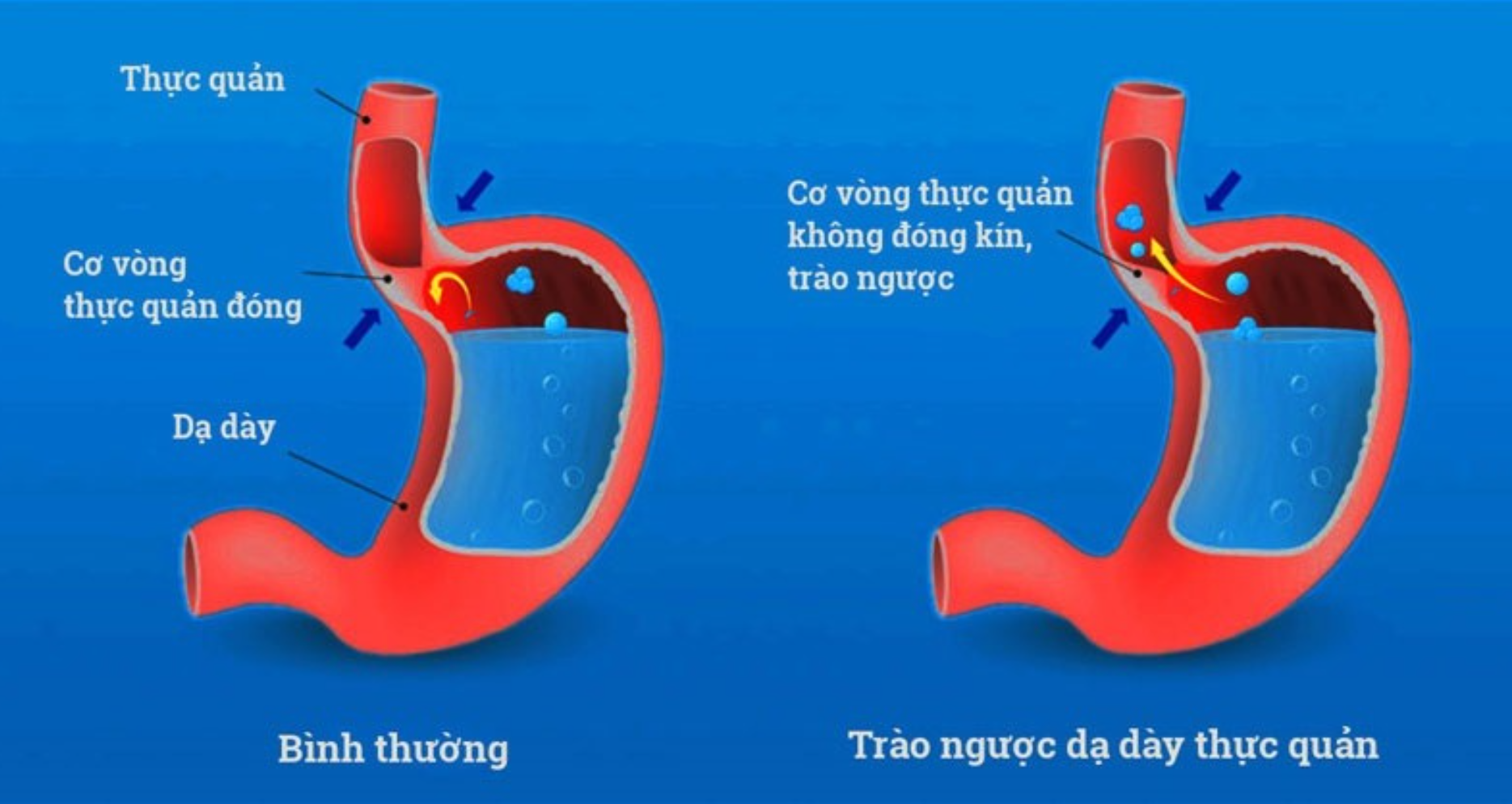 Trào Ngược dạ dày thực quản
