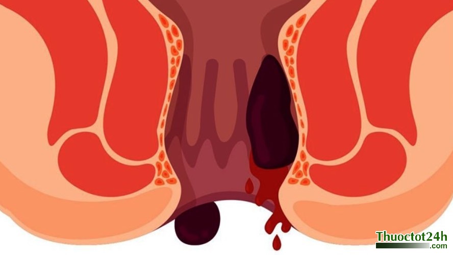 trĩ chảy máu có nguy hiểm không