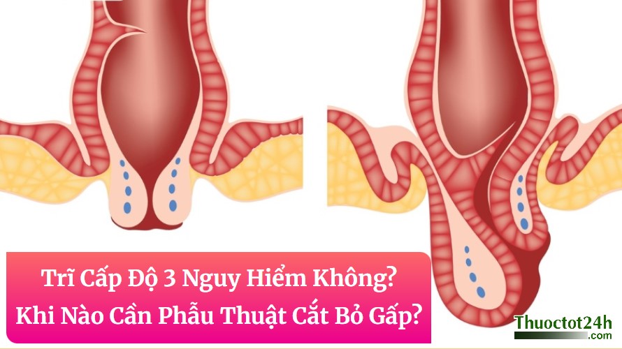Trĩ Cấp Độ 3 Nguy Hiểm Không? Khi Nào Cần Phẫu Thuật Cắt Bỏ Gấp?