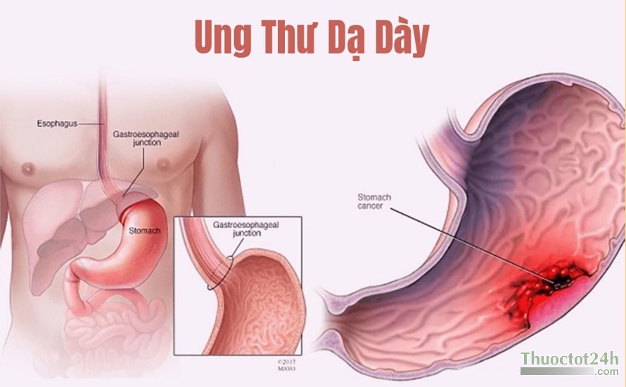 dấu hiệu nhận biết sớm ung thư dạ d&agrave;y