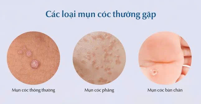 C&aacute;c loại mụn c&oacute;c