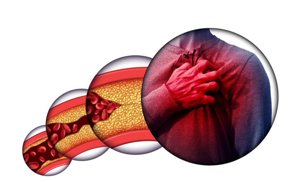 Dấu hiệu thiểu năng vành